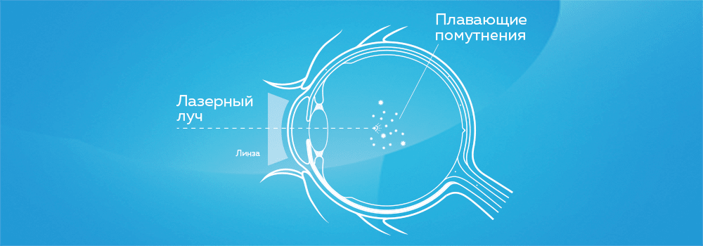 Схематическое изображение процедуры витреолизиса в клинике 3Z