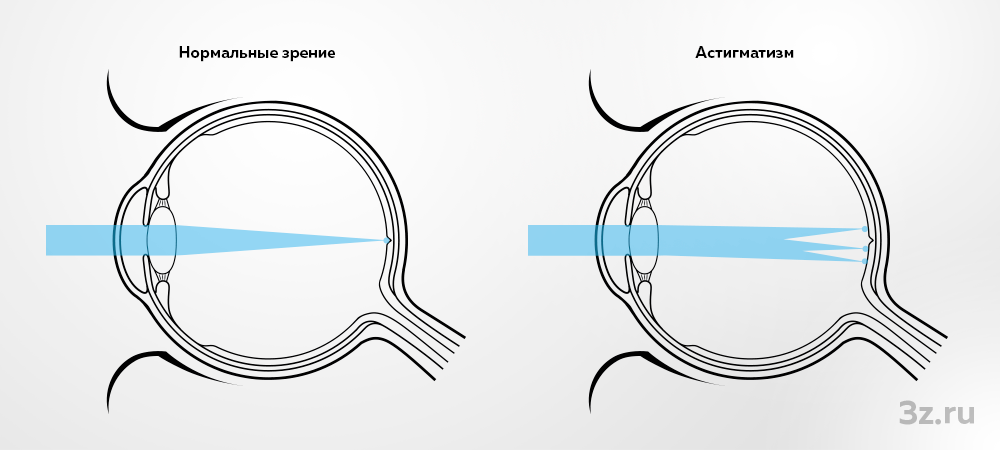 Астигматизм — 3Z