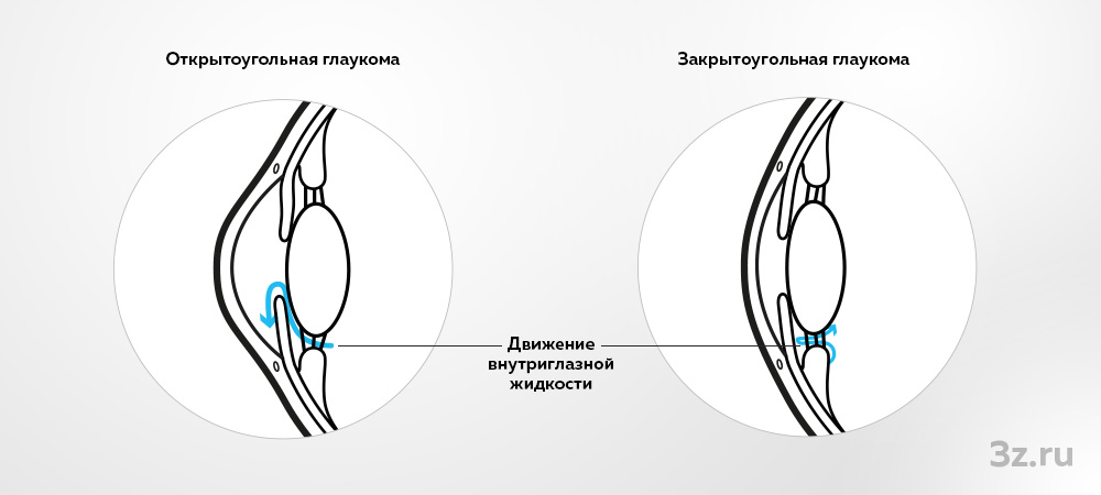 Открытоугольный и закрытоугольный виды глаукомы