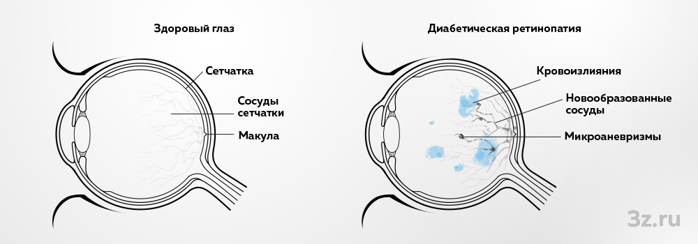 Глаз здорового человека и глаз пациента с диабетической ретинопатией