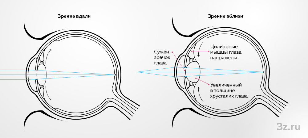 Спазм аккомодации — 3Z