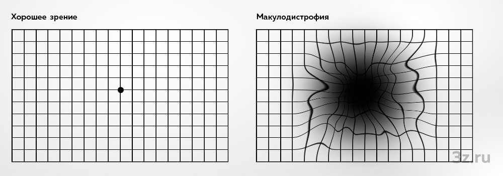 Макулодистрофия — 3Z